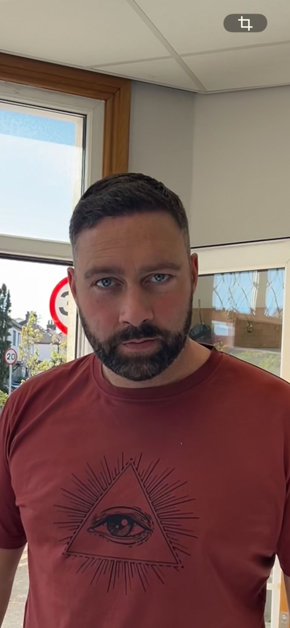 Hairline restoration — 6-month result